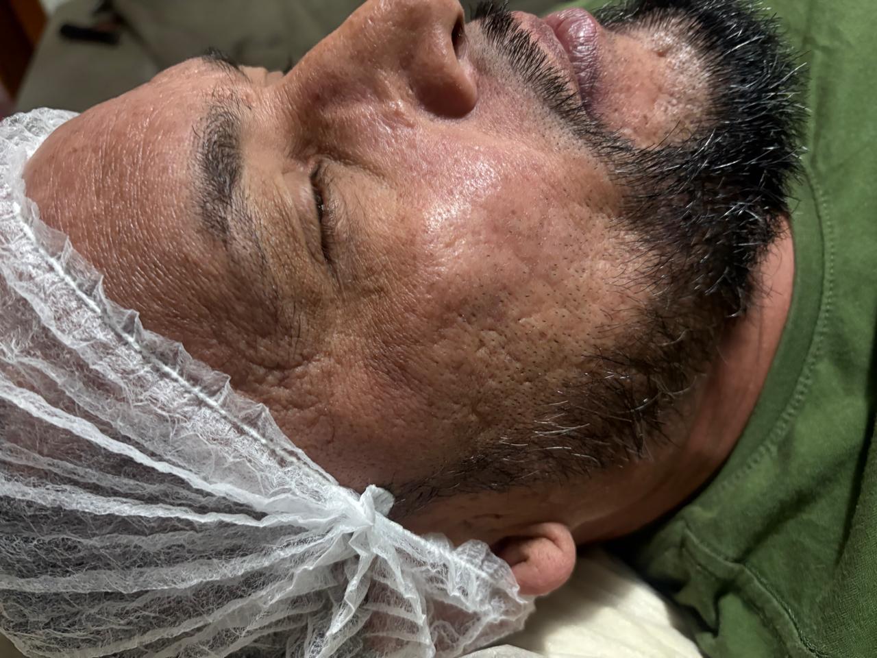 Registro anterior ao cuidado de microagulhamento facial