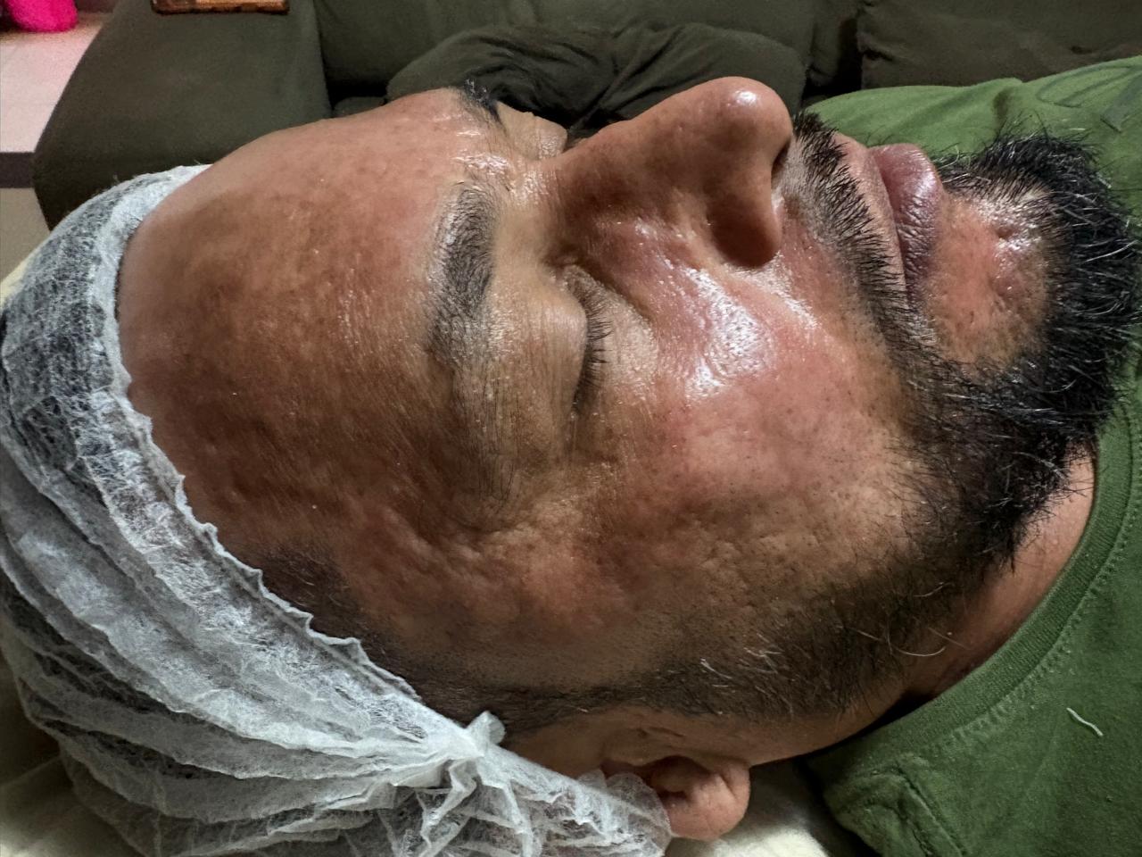 Registro posterior ao cuidado de microagulhamento facial
